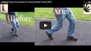 Video images of the bilateral drop foot solution for Charcot-Marie-Tooth