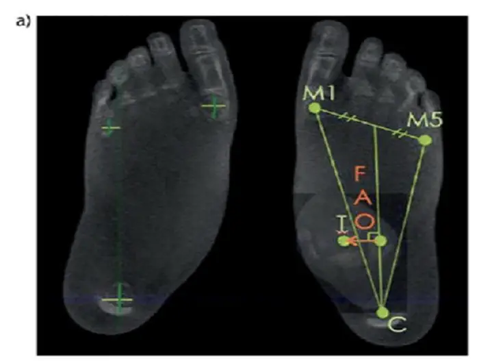 The Foot/Ankle Offset describes the distance of the talar dome from the midline of the base of support